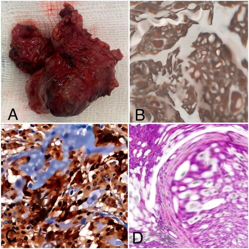 Figure 3. Mammary analogue secretory carcinoma (MASC) morphologic and histopathological features. (A) Macroscopic view of the tumor removed from the parotid gland (3 × 4 cm). (B) Mammoglobin immunohistochemistry of MASC mass. (C) S100 protein immunohistochemistry of MASC mass. (D) Hematoxylin-eosin stain of MASC mass.