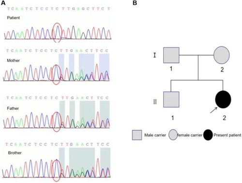 Figure 2. CYP17A1 sequencing and genetic map of Patient’s family. (A) Sequencing results of CYP17A1 of the patient, the patient’s mother, the patient’s father and the patient’s brother from top to bottom. The patient had a homozygous mutation of c.987del, while her parents and elder brother all had heterozygous mutations of c.987del; (B) Patient’s genetic map of 17α-OHD.