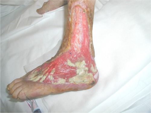 Figure 1 Ulcers of the lower limb at baseline, on admission.