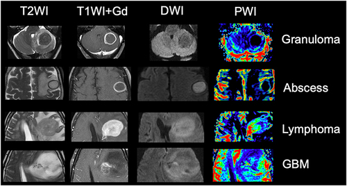 Figure 7 Note how MRI can help to differentiate a typical granuloma, from an abscess, and a high grade neoplasm. Granuloma typically has a hypointense signal on T2-weighted imaging, peripheral contrast enhancement, with no restricted diffusion and reduced rCBV. Abscess has hyperintense central signal on T2-weighted imaging, with central restricted diffusion and reduced rCBV, associated with a peripheral capsule which has hypointense signal on T2, as well as thin and regular contrast-enhancement. Lymphoma, in an immunocompetent patient, presents with hypointense signal on T2, restricted diffusion, diffuse contrast-enhancement and increased rCBV. A high-grade glioma, such as GBM, usually has heterogeneous signal on T2, with irregular contrast-enhancement and restricted diffusion, associated with increased rCBV in its solid portions. Although in general the rCBV of a lymphoma is not as high as the rCBV of a high-grade glioma, it is generally higher than the rCBV of inflammatory and infectious lesions, including granulomas and abscesses.