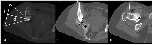 Figure 4. (a) CT-scan of a sclerotic metastasis (group (b)) of the ilium (dotted circle). L corresponds to the diameter of the transducer (100 mm) and d the distance between the focal point and the skin (d = 100 mm). (b, c) CT-scan showing cryoablation of the lesion performed with a 17-gauge cryoprobe inserted coaxially in a 14-gauge penetration set (b, arrow), associated with dissection (b, dotted arrow) of the sciatic nerve (b, star) and coxofemoral articulation (c, dotted arrow). Dissection fluid contains iodinated contrast (+) to optimize CT visibility.