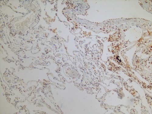 Figure 3 Immunohistochemistry image of an explant lung from a patient with combined pulmonary fibrosis and emphysema showing increased lysyl oxidase-like protein 1 (LOXL1) levels in fibrotic areas and decreased LOXL1 levels in emphysematous areas (brown=LOXL1; blue=nucleus; pink=cytoplasm).