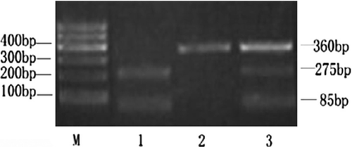 Figure 1. PCR-RELP analysis of V249I CX3CR1 gene polymorphisms. Amplified PCR products were digested with Acl I enzyme.Lane M, molecular marke, Lane 1, genotype VV, Lane 2, genotype II, Lane 3, genotype VI