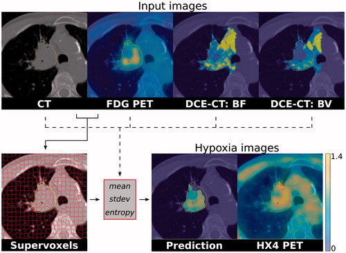 Figure 1. An example patient from the test set with the different imaging modalities, the supervoxel pre-processing and hypoxia images. On the top row, the images that are used as model input: CT, FDG PET, DCE-CT blood flow and blood volume, overlaid on the planning CT. Clustering is performed on the CT and FDG PET data to create supervoxels (solid line). For each supervoxel, the mean, standard deviation and entropy are calculated for each input imaging modality (dashed line). These features are combined in a random forest model to predict hypoxia TBR for every supervoxel. The missing values at the top of the GTV (the contoured structure) in the prediction image are supervoxels with high DCE-CT residuals (e.g., motion) and therefore excluded from analysis.