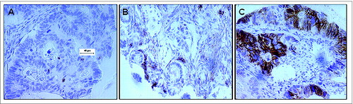 Figure 1. CD56 expression in the colorectal carcinoma microenvironment. Formalin-fixed paraffin-embedded tissue blocks of colorectal cancer (CRC) patient tumor specimens (n = 1410) were sectioned and stained with an anti–CD56 mAb. Following detection with a chromogenic substrate, the brown color shows CD56+ cells. (A) Representative example of CD56− CRC tumor punch with ≤4 CD56+ cells. (B) Representative example of CD56+ CRC patient tumor punch with chains of CD56+ cells >4. (C) IHC analysis detects CD56+ colorectal carcinoma cells.