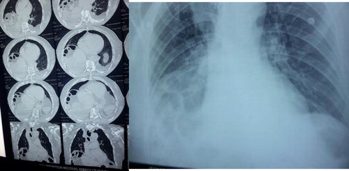 Figure 1: Left: Chest and abdominal CT scan showing interposition of colonic loop between the undersurface of the right dome of the diaphragm and the liver. Right: Chest X-ray showing gaseous shadows beneath the right dome of diaphragm.