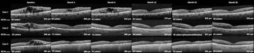Figure 3 Representation of the CMT evolution through SD-OCT in three patients with 36-month follow-up. CMT and BCVA data are presented. Important to note that case 2 developed a cataract after FAc implant and was submitted to cataract phacoemulsification during a 12–24-month follow-up.
