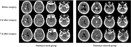 Figure 3 Imaging of IVH patients shown as representative cases. CT scans performed before, 3d and 7d after surgery of Ommaya-used group and Ommaya-unused group. The mGS scores were 20 (before surgery), 16 (3d after surgery) and 5 (7d after surgery) of representative case in Ommaya-used group. The mGS scores were 13 (before surgery), 11 (3d after surgery) and 5 (7d after surgery) of representative case in Ommaya-unused group.