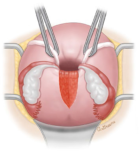 Figure 3 The Haultain procedure for management of uterine inversion involves making an incision in the posterior surface of the uterus to bisect the constriction ring in the myometrium, which is preventing reduction of the inversion. Reproduced from 2022 UpToDate, Inc. Puerperal Uterine Inversion.