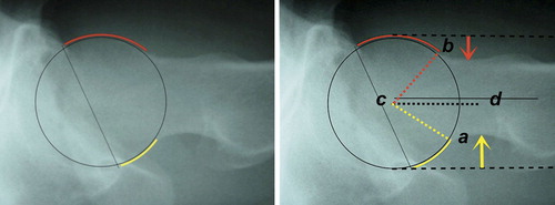 Figure 31. Identical radiographs of the “normal” human hip show, on the left, anterior “uncovering” of femoral head (red crescent). On the right: larger concavity posterior than anterior, in this case due to both low beta angle (beta angle a–c–d = 30°, vs. alpha angle b–c–d = 48°) and increased posterior offset (yellow arrow vs. anterior offset, red arrow). Cross table lateral radiograph (perpendicular to the femoral neck), anterior is up, posterior is down.