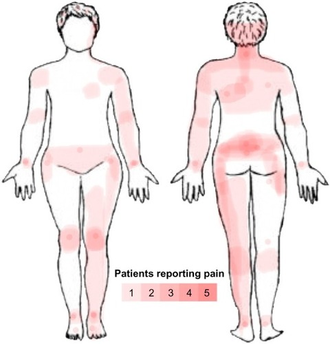 Figure 1 Body map over pain location in CP group.