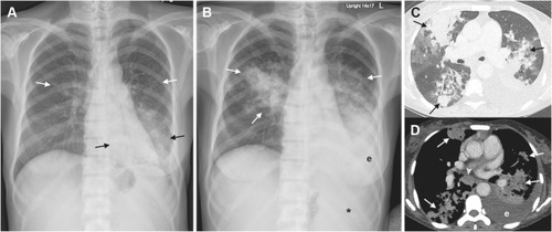 Figure 1 (A) Initial chest radiograph showing extensive airspace consolidation in the left lower lobe (black arrows) and numerous fine nodular opacities in both lungs (white arrows). There is no pleural effusion. Note a diffuse increase in bone density associated with the underlying MF. (B) Follow-up chest radiograph showing marked progression of bilateral pulmonary abnormalities and development of left pleural effusion (e). Note an enlarged splenic shadow (asterisk in (A) causing medial displacement of the gas-filled stomach. (C–D) Subsequent axial chest CT scans with lung-window (C) and mediastinal-window (D) settings showing multifocal consolidations (arrows) in bilateral upper and lower lobes with modest-sized left pleural effusion (e). Also, note an enlarged subcarinal lymph node with heterogeneous contrast enhancement (arrowhead in (C).