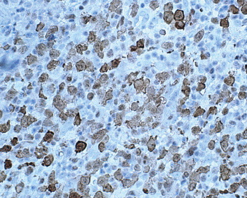 Figure 2. Biopsy of an enlarged inguinal lymph-node. Immunostaining showed the large cells were positive for ALK-1 (×400).
