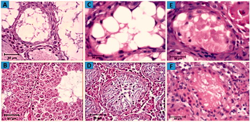 Figure 7. Assessment of morphological changes. H&E staining showing the morphology of mouse testes after 4 weeks of 40 mg/kg busulfan treatment most seminiferous tubules are depleted and no spermatogenetic activity. (A) Wild type mouse testis without busulfan treatment, seminiferous tubules contain spermatogonia, spermatid and spermatozoa. (B) Host testis 2 weeks after iPSCs transplantation and morphological changes from in vivo studies. Restoration of spermatogenesis in seminiferous tubule following iPSCs transplantation is illustrated (C) compared to the control group (D). Histological section of testis fragment cultured for 2 weeks following iPSCs transplantation and 3D organ culture. Due to the cutting of seminiferous tubules, they are not seen regularly in the tissue section. The initiation of spermatogenesis process is visible in the seminiferous tubule of host testis fragments (E) in comparison to control testis (F).