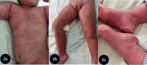 Figure 2 (a–c) Skin flushing in the forechest due to EP on April 25 gradually spread to the entire body, accompanied by dry yellow scabs and an absence of obvious pustules.