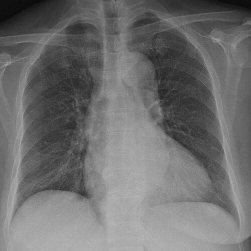 Figure 1. Preoperative X-ray. A chest X-ray examination showed that there was a little inflammation in both lungs.