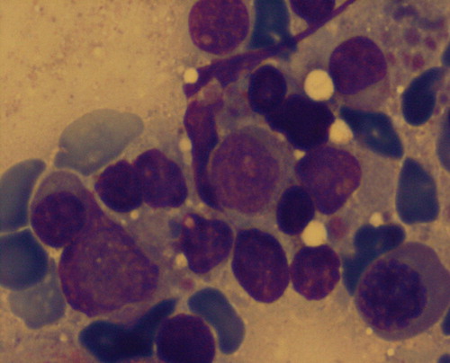 Figure 2. Type II agranulocytosis showed rare granulocytic precursors (×1000).