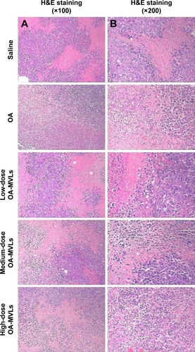 Figure 10 In vivo study of tumor cells death resulted from OA and OA-MVLs at different doses.Notes: The H22 tumor-bearing mice were treated as mentioned earlier with saline, OA, low-dose OA-MVLs, medium-dose OA-MVLs, or high-dose OA-MVLs. Tumor sections in (A) (×100) and (B) (×200) were excised, fixed, dewaxed, and followed by standard H&E staining for determining necrosis rate.Abbreviations: OA, oleanolic acid; OA-MVLs, oleanolic acid-encapsulated multivesicular liposomes; H&E, hematoxylin and eosin.