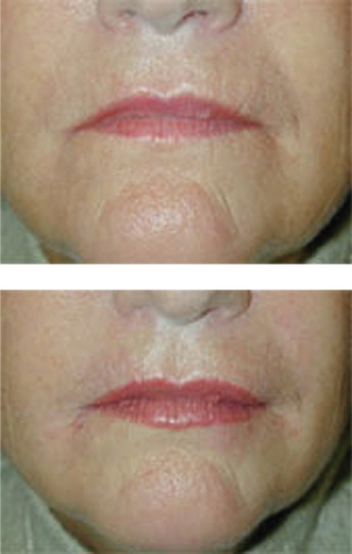 Figure 1 A clinical example of the use of Hylaform® for lip augmentation.
