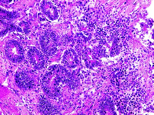 Figure 5.  Diffuse pericryptal mononuclear cell hyperplasia (lymphocytes) and fibroplasia in the duodenum. H & E stain (scale bar= 50 µm).