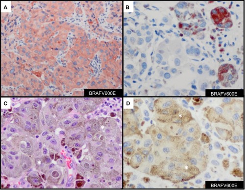 Figure 6 Immunohistochemcial evaluation of BRAFV600E mutation status in melanoma.