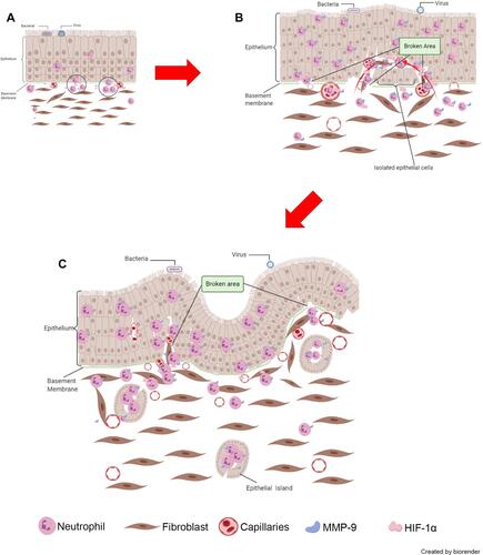 Figure 7 Proposed model of neutrophil and MMP-9’s role in the initiation of NIP formation. (A) MMP-9 from infiltrating neutrophils dissolved the basement membrane, leading to inflammatory cells moving into the epithelium. (B) Under the co-effect of HIF-1α, the formation of finger-like projections was enhanced. (C) The distortion and formation of NIP and surrounding epithelial islands resulting in the unique histopathological characteristics of NIP. The photos were created by BioRender.com.