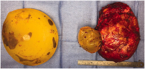 Figure 3. Intraoperative photograph of bilateral explanted, textured, silicone breast prostheses and right breast capsule. There is evidence of bilateral rupture with hematoma within the implants.