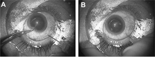 Figure 9 LiDrape® in intravitreal injection. (A) Injection performed 3.5 mm from the limbus. (B) The eyelashes and the eyelids were completely draped.