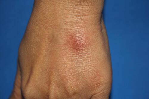 Figure 3 Erythema nodosum at the dorsum of the left hand in a patient diagnosed with acute myeloid leukemia.