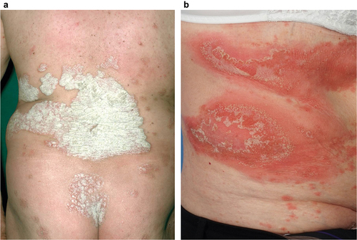 Figure 1. Dermatologic presentation of PV (a) and GPP (b). PV is characterized by the presence of discrete scaly plaques, whereas the appearance of GPP is dominated by multiple coalescing white/yellowish pustules. Images courtesy of Dr. Burden. GPP, generalized pustular psoriasis; PV, psoriasis vulgaris.