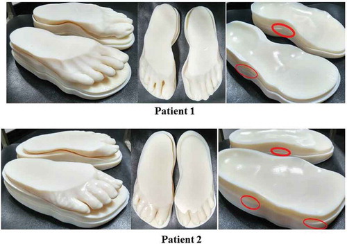 Figure 5. Top views of the RP model prototype assembly for two diabetic patients.