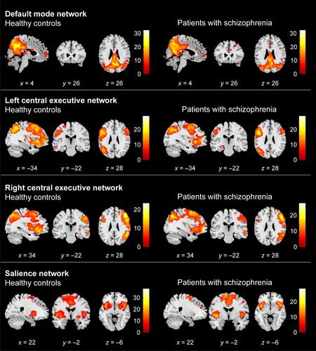 Figure S2 Comparison of connectivity maps for patients and controls across three RSNs (DMN, CEN, and SN).Notes: Spatial maps are shown based on t-statistics with significance defined as FWE-corrected p < 0.05. Each RSN map was highly correlated with the RSN template (DMN, CEN, and SN),Citation7 respectively. The groups had similar DMN and CEN expressions. We could not find any significant group differences in DMN nor CEN.Abbreviations: CEN, central executive network; DMN, default mode network; RSN, resting-state network; SN, salience network; FWE, family-wise error.