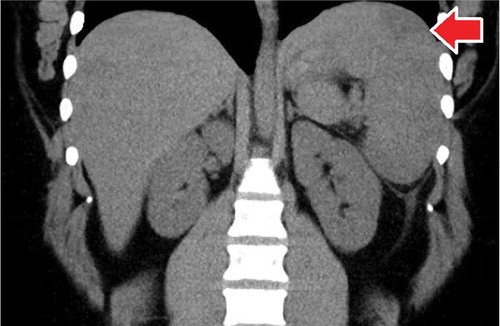 Figure 1. An enlarged spleen measuring 15.3 by 6.0 by 14.5 cm with a wedge-shaped infarct.