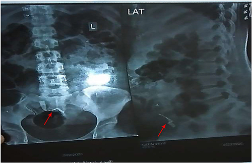 Figure 1 Abdominal X-ray(red arrow) showing the presence of radiopaque material(abdominal compress) in the abdomen.