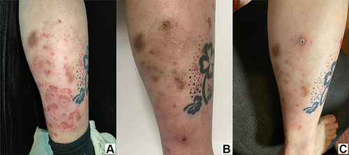 Figure 2 Cutaneous aspergillosis on a right lower limb. (A) Papules and erythematous plaques covered with pustular eruption. (B) One month after the initiation of treatment. (C) Three months after the initiation of treatment.