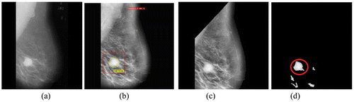 Figure 5. (a) Malignant image mdb028 (b) Its preprocessed image with abnormalities recorded (c) With pectoral muscles removed and (d) Segmented ROIs.