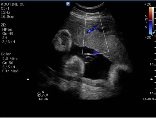 Figure 3 Doppler of the myometrial placental junction showing a reduced flow at the time of diagnosis of intrauterine growth restriction.