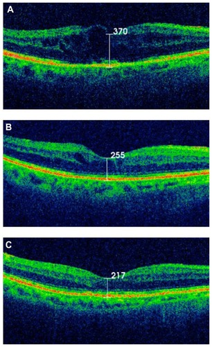 Figure 2 (A) Vertical section of the macular area of the left eye by optical coherence tomography showing cystoid macular edema. (B) Vertical section of the macular area of the left eye 2 days after subtenon triamcinolone injection. A quick recovery with a mild case of cystoid macular edema was observed. (C) Three years after subtenon triamcinolone injection, no recurrence of cystoid macular edema was observed.
