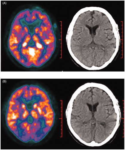 Figure 2. (A) Initial 18 F–FDG PET/CT scan showing hypermetabolic activity mainly in bilateral lateral ventricle, bilateral cavernous sinus, left temporal lobe and cerebellum. (B) Repeated 18 F-FDG PET/CT showed great decrease of number and size of intracranial lesions with only a high-uptake locus in cave sinus remained.