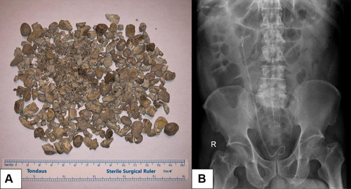 Figure 9 (A) Evacuated stone fragments during the procedure; (B) Postoperative KUB photo showed no residual stone in the right kidney with correctly positioned DJ stent.