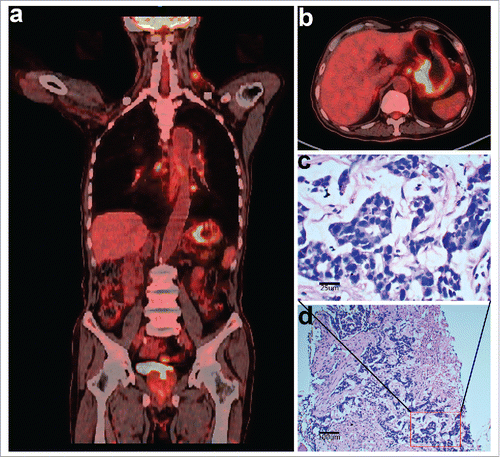 Figure 1. Imaging and histopathologic characteristics of the patient at the first diagnosis. (a and b) Positron emission tomography/computed tomography (PET-CT) scans showing heterogeneous fluorodeoxyglucose (FDG) uptake in multiple lymphadenopathies and gastric lesions. (c and d) Hematoxylin and eosin staining of biopsy tissues of the left neck lymph nodes confirmed metastatic adenocarcinoma (400 × magnification and 100 × magnification, respectively).