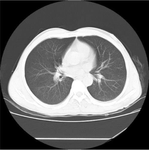 Figure 5 Computed tomography (CT) of breast showed no lung metastases.
