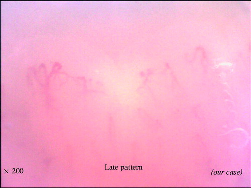 Figure 6. Representative photograph of ‘late pattern’.