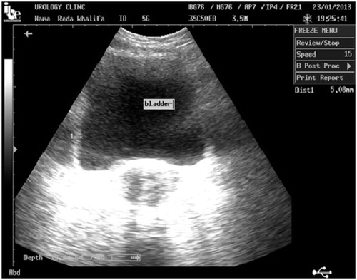 Figure 2. Bladder wall thickness ≥5 mm.