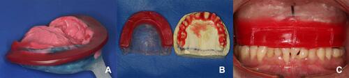 Figure 7 Initial impressions with a custom tray (A). Base plaque and wax guide plane performed over the patient teeth (B). Maxillomandibular records (C).