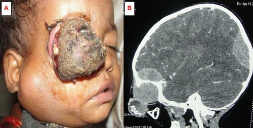Figure 3 (A) Clinical photograph of a male child with an orbital retinoblastoma on the right eye. (B) Computed tomography in the sagittal view showing intracranial extension with lymph node and cerebral metastasis.