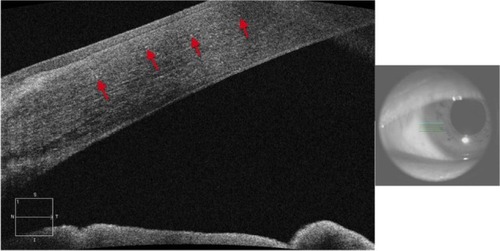 Figure 17 Anterior segment SD-OCT image demonstrating hyper-reflective crystals (red arrows) in the limbus area of the eye of a patient with Bietti crystalline dystrophy (BCD).