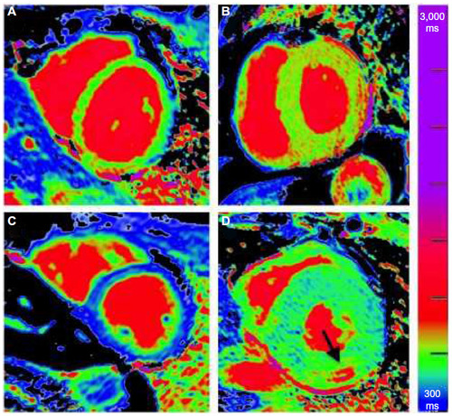 Figure 3 Native T1 maps in the basal short axis.