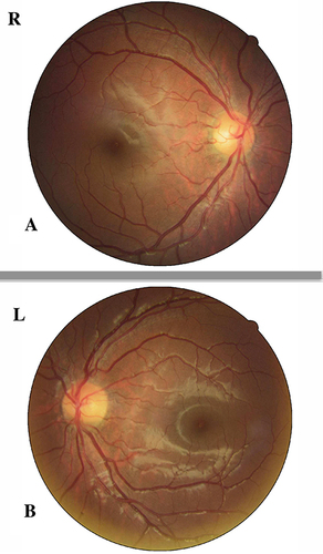 Figure 2 Fundus images of both eyes. The optic disc was not swollen in our case and the retrobulbar optic neuritis was considered.