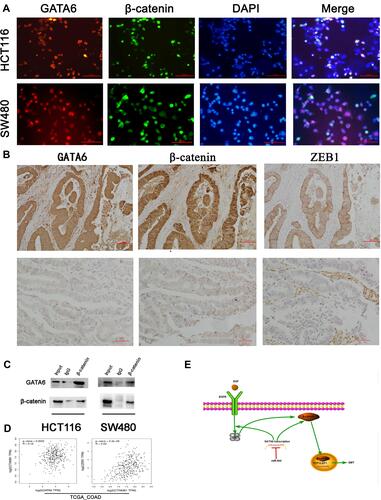 Figure 4 The association between miR-944-GATA6 and wnt-β-catenin signaling pathway in two CRC cell lines and CRC tissues. (A) The co-staining of GATA6 with β-catenin in HCT116 cells and SW480 using a fluorescence microscope. (B) Co-expression of miR-944 with GATA6, β-catenin, and ZEB1 in low miR-944 tissue and high miR-944 tissue using Immunohistochemistry. (C) β-catenin co‐immunoprecipitated with GATA6 in HCT 116 and SW480 cells. The input and IgG lanes were used as the positive and negative controls, respectively. (D) Co-expression analysis showing a positive relationship between GATA6 and β-catenin, β-catenin and ZEB1 in TCGA_COAD dataset by GEPIA, (E) the diagram illustrating how miR-944 decreased the EMT by inhibiting the GATA6 mediated Wnt/β-catenin signaling pathway activity n = 3.